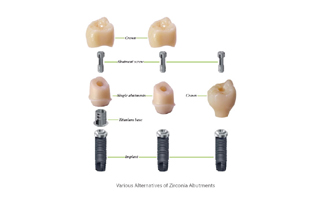 Custom Zirconia Abutment