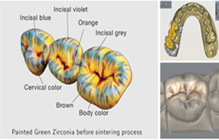 Full Zirconia